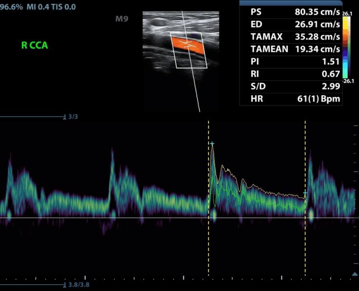 triplex aggeion
