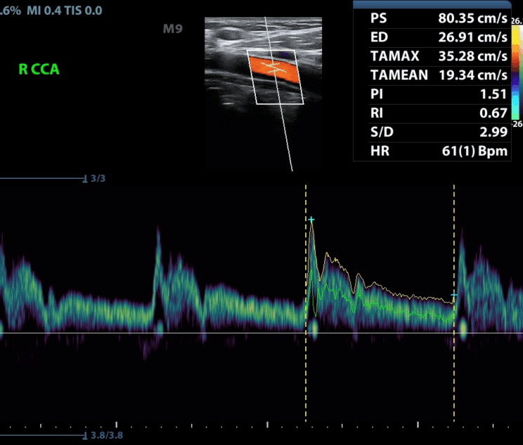 triplex aggeion